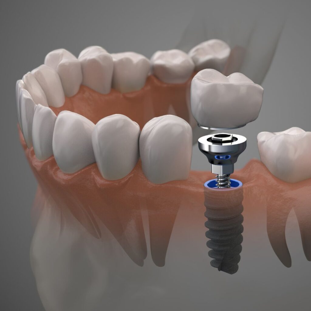 dental implant aberdeen nj