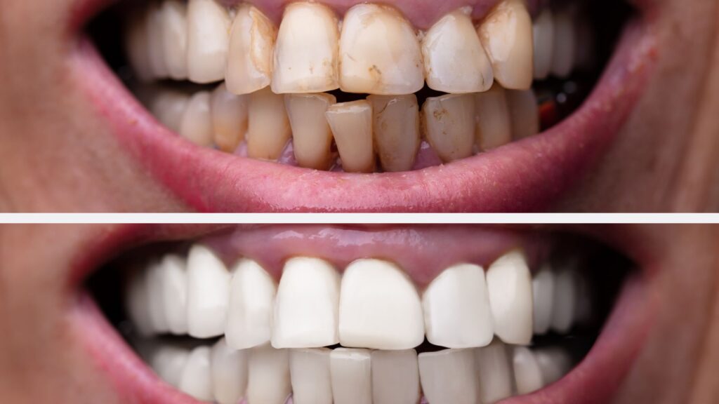 What causes teeth discoloration and how to prevent it?